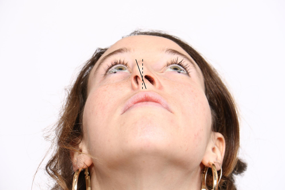armonizacion nasal