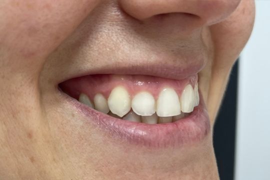 Aumento de labios en Málaga - foto despues