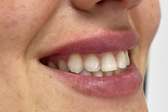 Aumento de labios en Málaga - foto antes