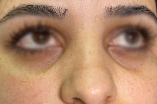 Ojeras y bolsas - foto despues