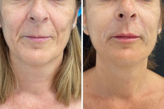 Aumento de labios en Málaga - foto antes