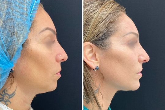 Rejuvenecimiento facial - foto antes