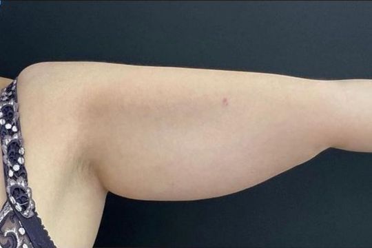 Liposupción con lipoláser - foto despues