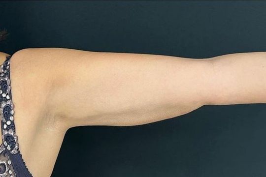 Liposupción con lipoláser - foto antes