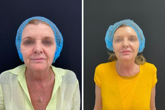 Rejuvenecimiento facial - foto antes