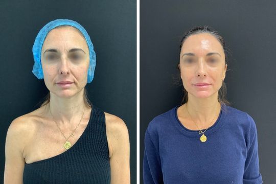 Rejuvenecimiento facial - foto antes