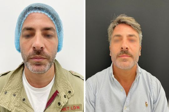 Rejuvenecimiento facial - foto antes
