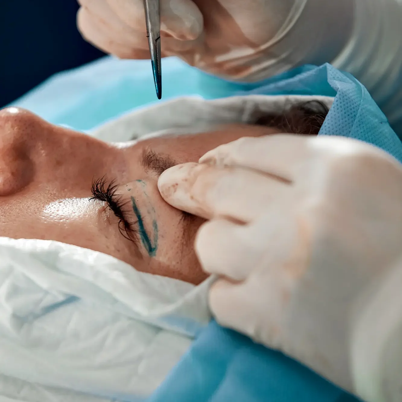 Blefaroplastia Málaga