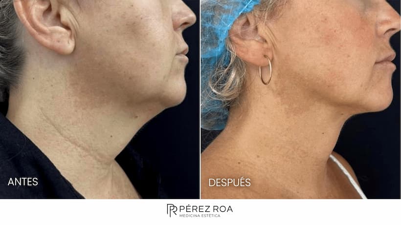 Endolifting de papada - foto antes