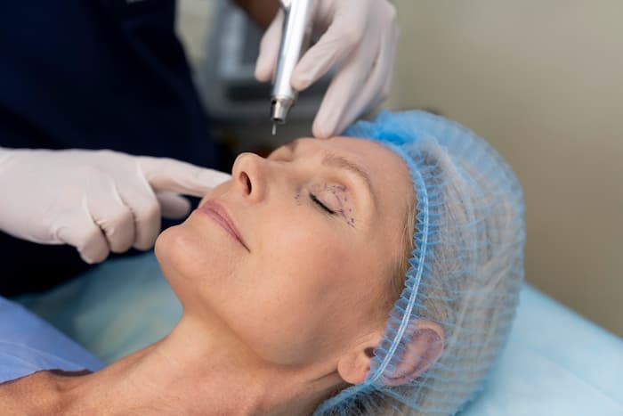 recuperación blefaroplastia