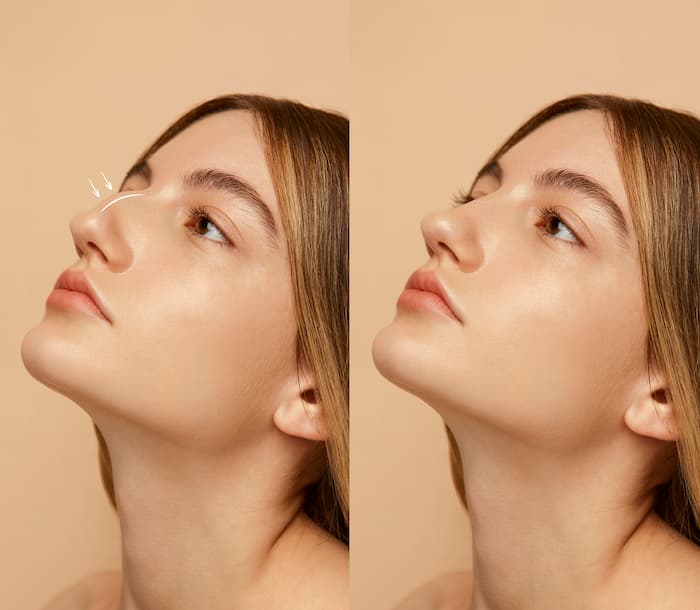 Operación rinoplastia sin cirugía: resultados increíbles