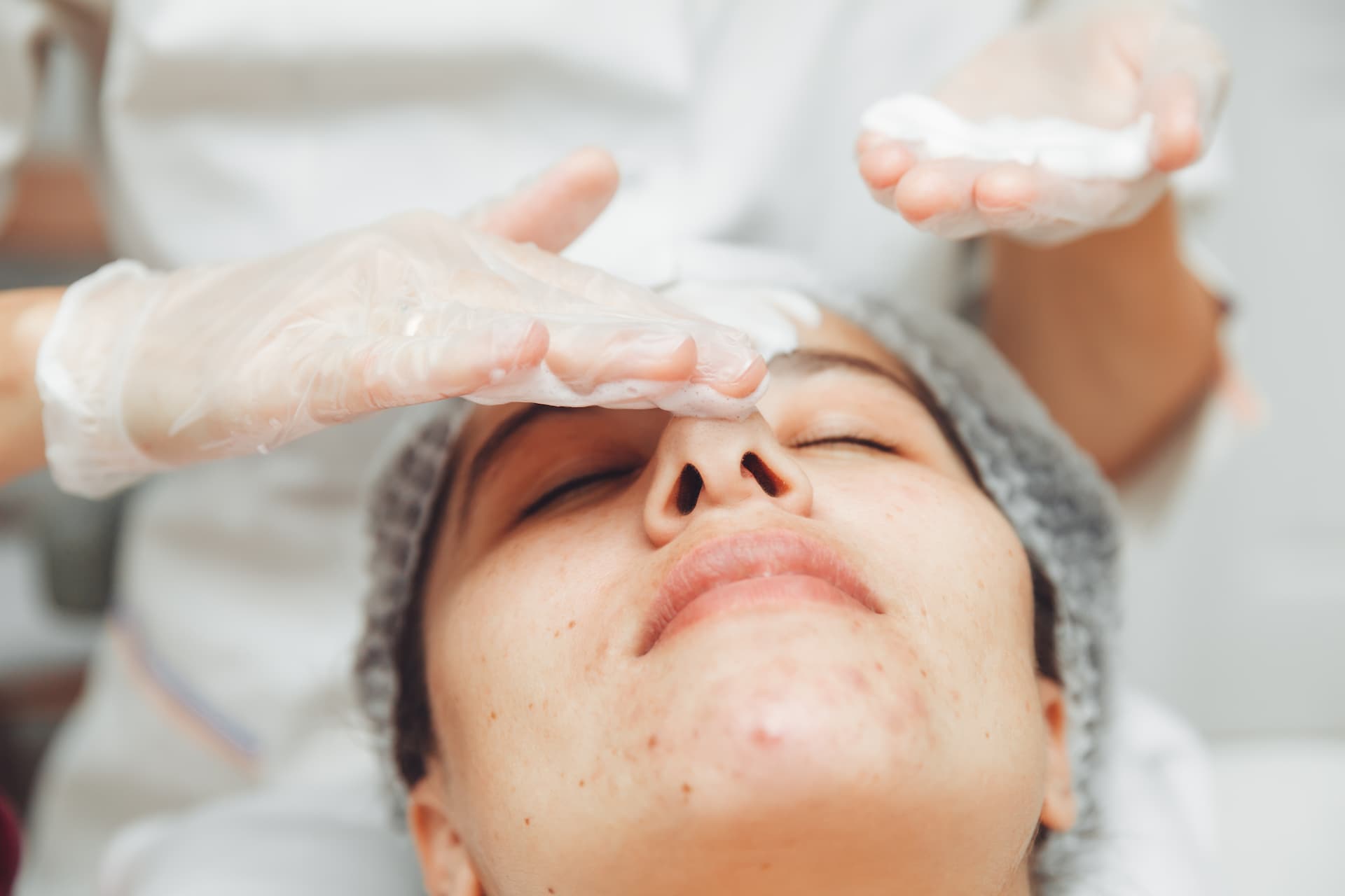 Tratamientos de estética para eliminar el acné