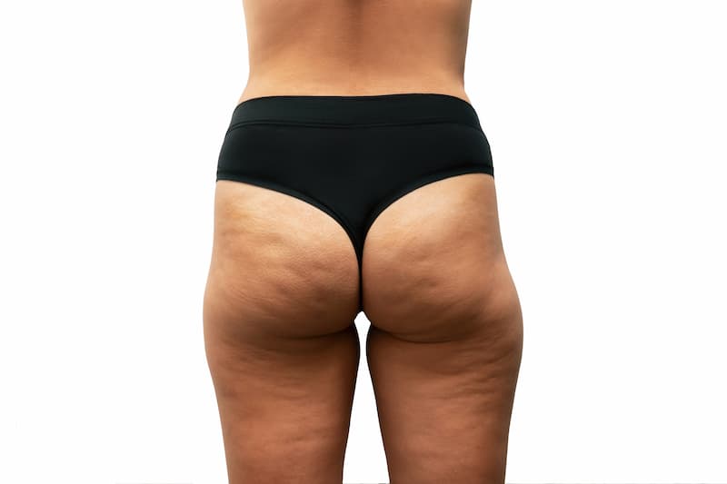 lipo de piernas en málaga