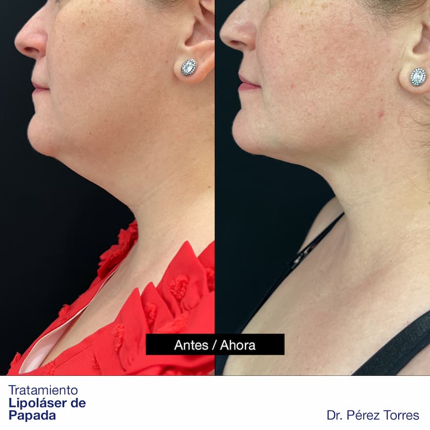 zonas lipolifting antes y despues