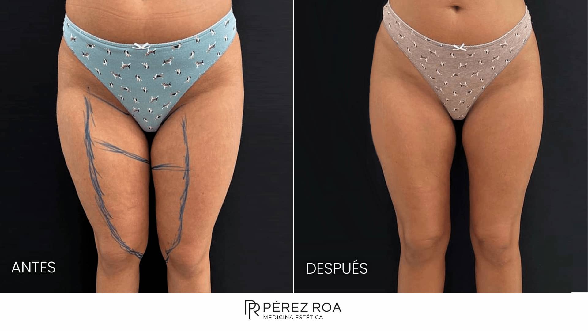 Precio del lipoláser: Todo lo que necesitas saber