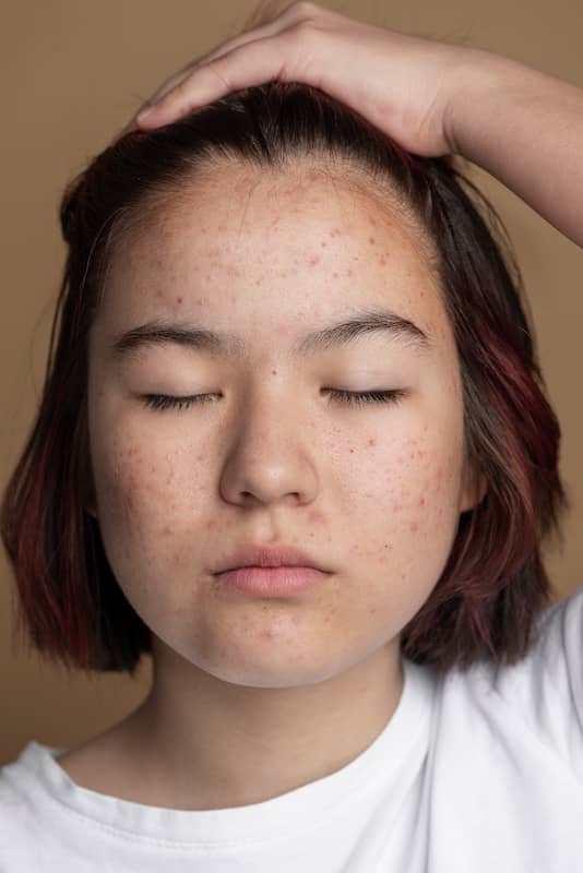 Tratamientos para eliminar las manchas