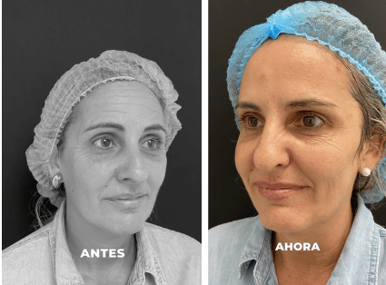 Tratamiento para arrugas profundas