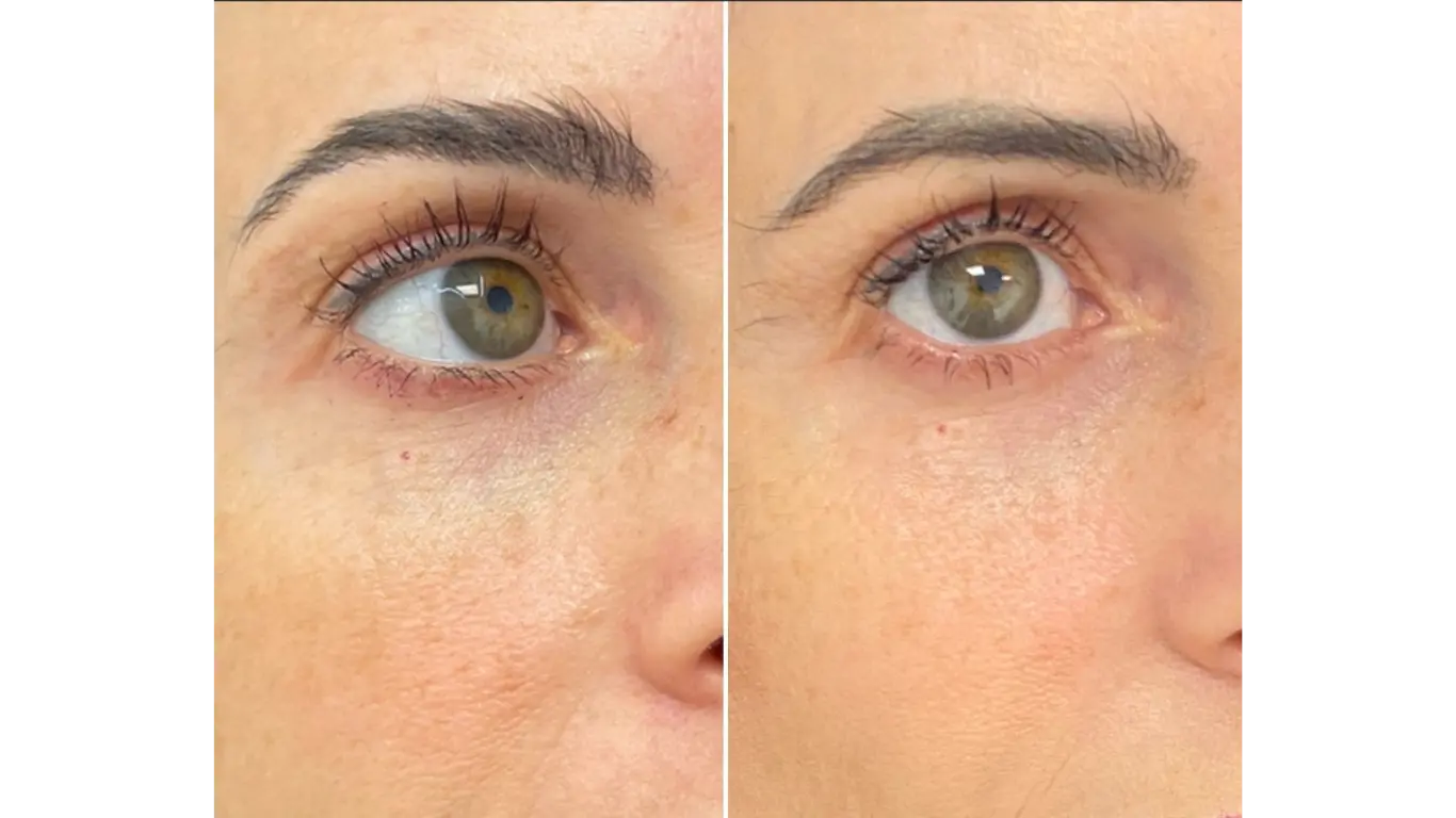 Microneedling: ¿Qué es y cómo puede transformar tu piel?